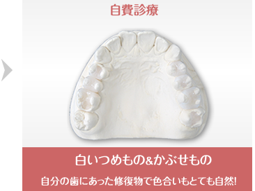 自費診療=白いつめもの&かぶせもの自分の歯にあった修復物で色合いもとても自然!