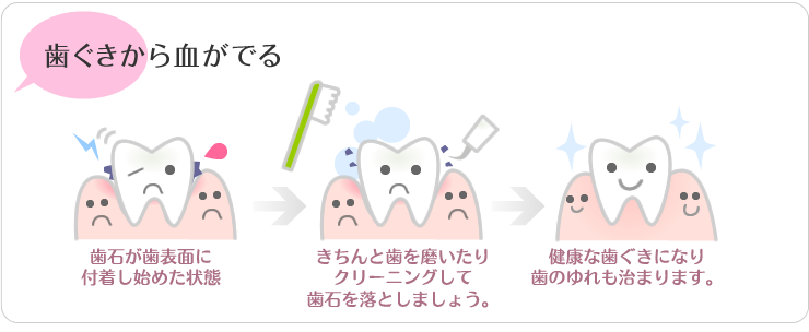 歯茎から血が出る。歯石が歯の表面に付着しはじめた状態。きちんと歯を磨いたりクリーニングして歯石を落としましょう。健康な歯茎になり歯の揺れもおさまります。