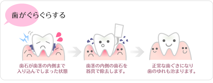 歯がグラグラする(歯石によるゆれ)歯石が歯茎の内側まで入り込んでしまった状態。歯茎の内側の歯石を器具で除去します。正常な歯茎になり歯の揺れもおさまります。