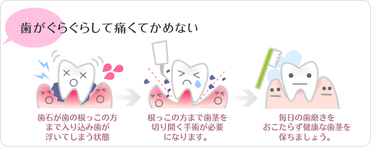 歯がぐらぐらして痛くて噛めない（歯石・歯周病）