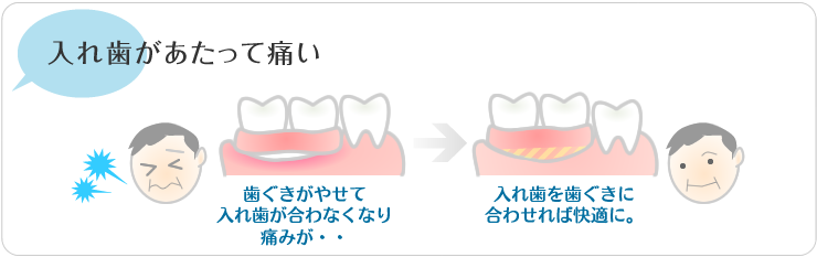 入れ歯があたって痛い歯茎がやせて入れ歯が合わなくなり、痛みが。入れ歯を歯茎に合わせれば快適に。