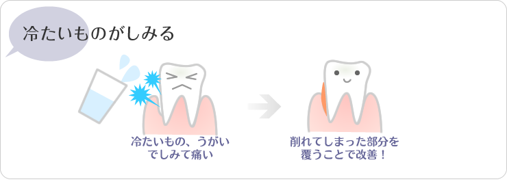 川越の歯科本川越歯科の冷たいもの、うがいでしみて痛い場合は削れてしまった部分を覆うことで改善！