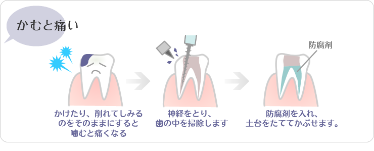 (1)かけたり、削れてしみるのをそのままにすると噛むと痛くなる。(2)神経をとり、歯の中を掃除します(3)防腐剤をいれ、土台をたててかぶせます。