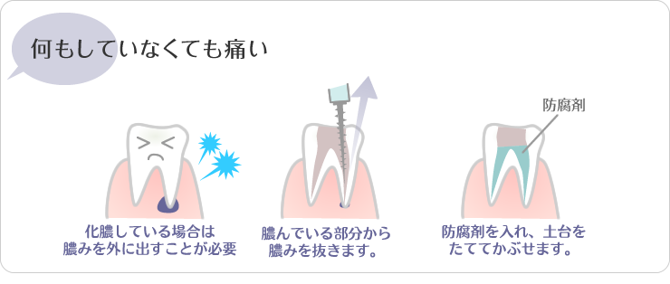 川越の歯科・本川越歯科の何もしていなくても歯が痛い。化膿している場合は膿みを外に出す事が必要。膿んでいる部分から膿みを抜きます。防腐剤をいれ、土台をたててかぶせます。