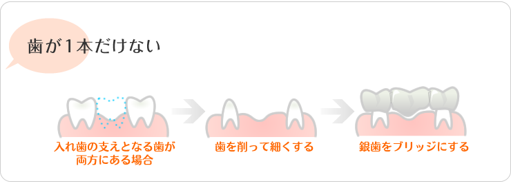 歯が一本だけない。入れ歯の支えとなる歯が、両方にある場合。歯を削って細くする。銀歯をブリッジにする。