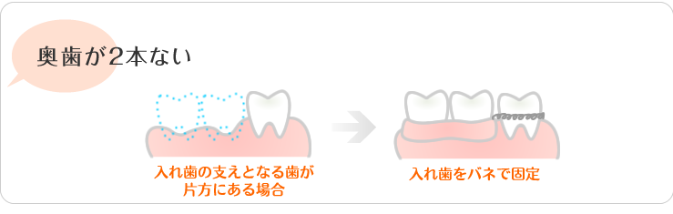 奥歯が2本ない。入れ歯の支えとなる歯が片方にある場合。入れ歯をバネで固定。