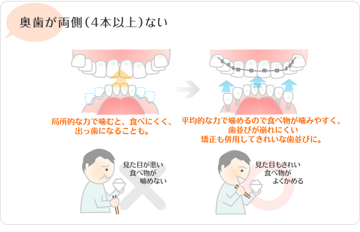 奥歯が両側4本以上ない。局所的な力で噛むと食べにくく、出っ歯になる事も。平均的な力で
                噛めるので食べ物が噛みやすくは並びが区連れに食い。矯正も併用してきれいな歯並びに。