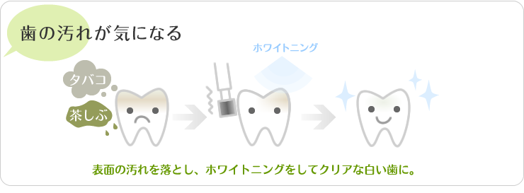 歯の汚れが気になる。表面の汚れをお年、ホワイトニングをしてクリアな白い歯に。