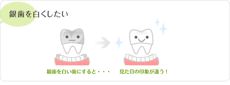 銀歯を白くしたい・銀歯を白い歯にすると、見た目の印象が違う