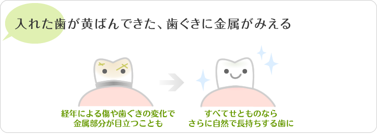 入れた歯が黄ばんできた、歯茎に金属が見える。経年による傷や歯茎の変化で金属部分が目立つ事も。すべてせとものならさらに自然で長持ちする歯に。