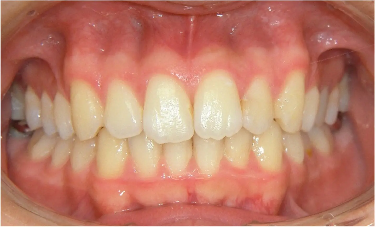 術後・一般歯科医矯正（インビザライン）治療の症例