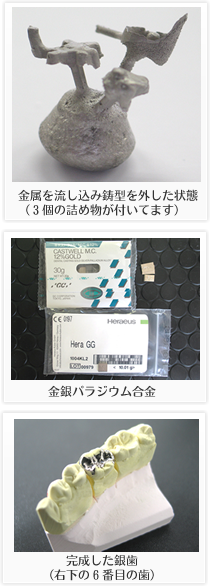 金属を流し込み鋳型を外した状態 (3個の詰め物が付いてます) 金銀パラジウム合金完成した銀歯
(右下の6番目の歯)