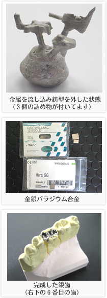 金属を流し込み鋳型を外した状態 （３個の詰め物が付いてます） 金銀パラジウム合金完成した銀歯
（右下の６番目の歯）