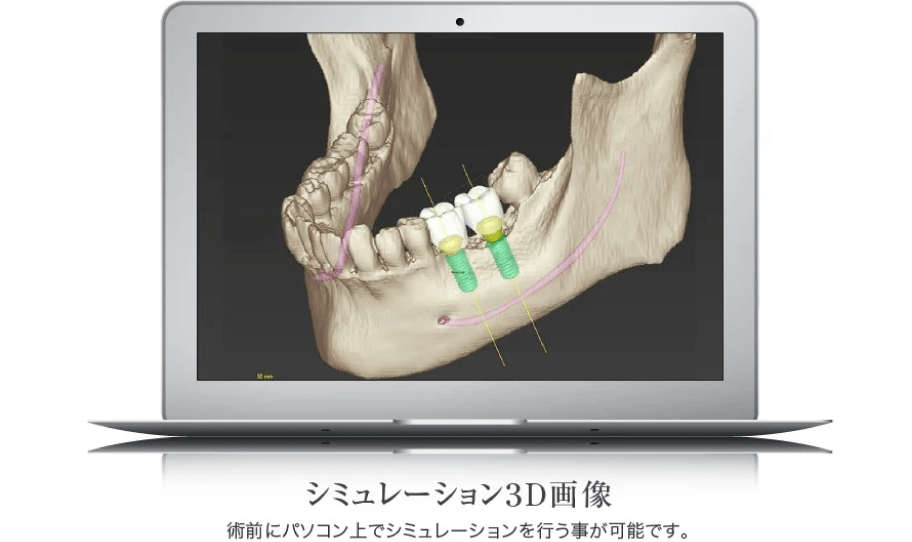 インプラントガイドシステム