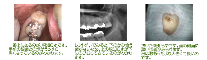 一番上にあるのが、親知らずです。 手前の銀歯との境がうっすら 黒くなっているのがわかります。レントゲンでみると、下のかみ合う歯がないため、上の親知らずが下にのびおりてきているのがわかります。 抜いた親知らずです。歯の側面に黒い虫歯がみられます。 根はおもったより大きくて長いのです。