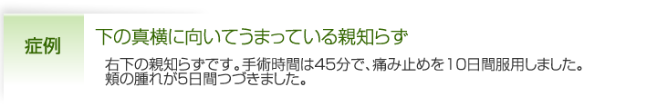 下の真横に向いてうまっている親知らず|右下の親知らずです。手術時間は45分で、痛み止めを10日間服用しました。
頬の腫れが5日間つづきました。