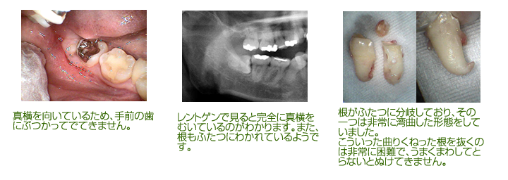 真横を向いているため、手前の歯にぶつかってでてきません。 レントゲンで見ると完全に真横をむいているのがわかります。また、根もふたつにわかれているようです。 根がふたつに分岐しており、その一つは非常に湾曲した形態をしていました。 こういった曲りくねった根を抜くのは非常に困難で、うまくまわしてとらないとぬけてきません。