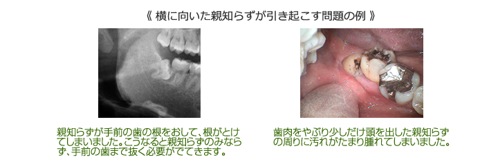 《 横に向いた親知らずが引き起こす問題の例 》 親知らずが手前の歯の根をおして、根がとけてしまいました。こうなると親知らずのみならず、手前の歯まで抜く必要がでてきます。歯肉をやぶり少しだけ頭を出した親知らずの周りに汚れがたまり腫れてしまいました。