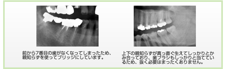 前から7番目の歯がなくなってしまったため、 親知らずを使ってブリッジにしています。上下の親知らずが真っ直ぐ生えてしっかりとかみ合っており、歯ブラシもしっかりと当てているため、抜く必要はまったくありません。